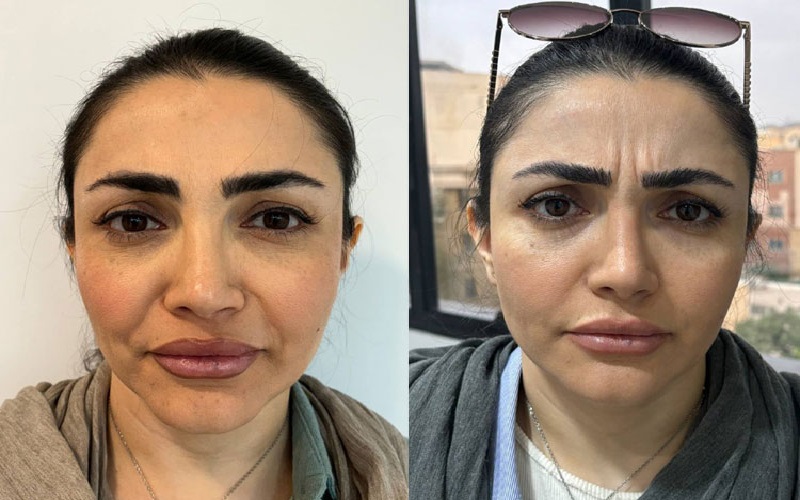 تزریق بوتاکس در اصفهان