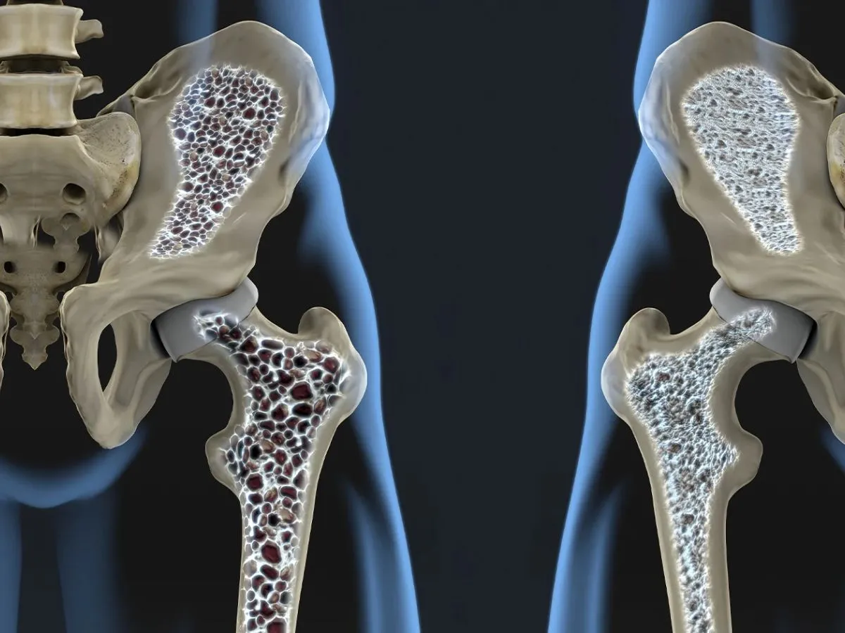 پوکی استخوان (استئوپروز)؛ نقش حیاتی کلسیم و ویتامین D در حفظ استحکام اسکلت بدن پوکی استخوان (استئوپروز)؛ نقش حیاتی کلسیم و ویتامین D در حفظ استحکام اسکلت بدن